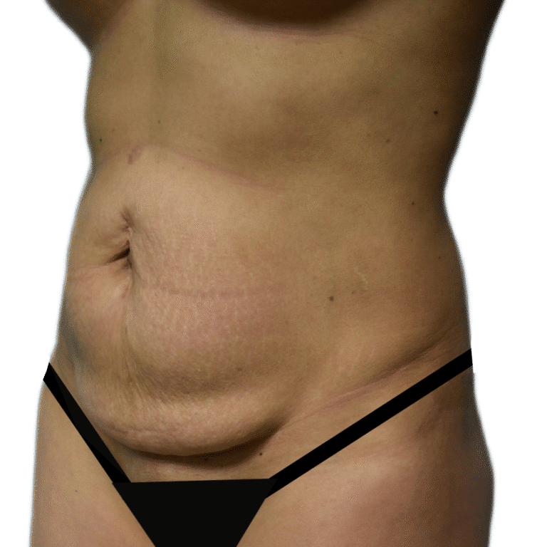 Before Image: Tummy Tuck - left-front-oblique
