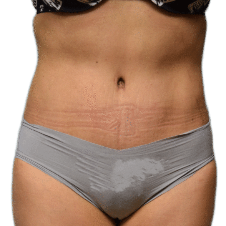 After Image: Tummy Tuck - front