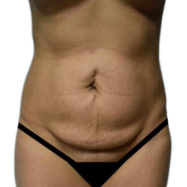 Before Image: Tummy Tuck - front