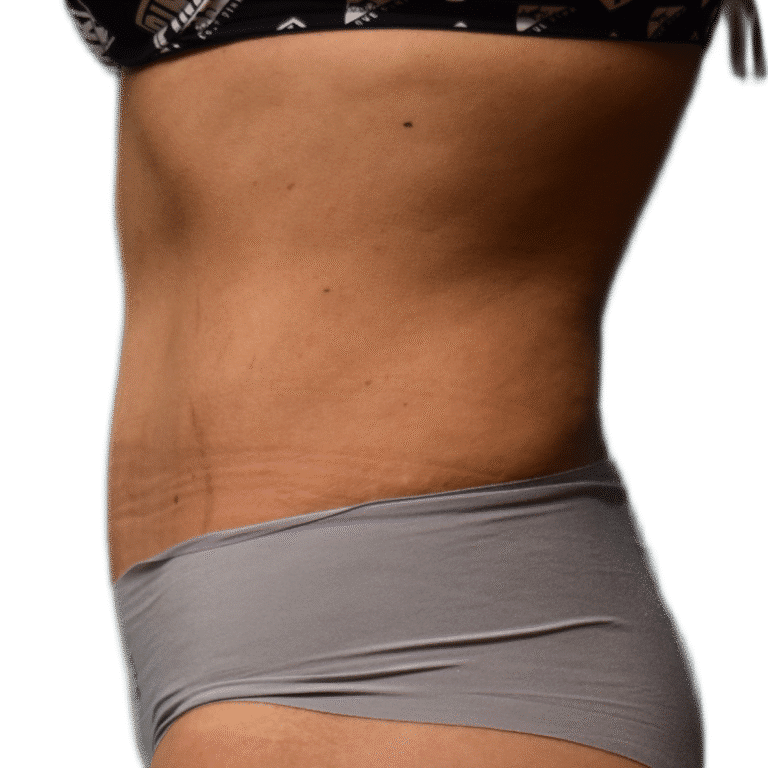 After Image: Tummy Tuck - left-side