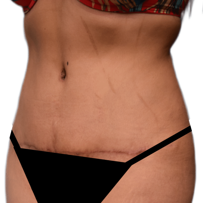 After Image: Tummy Tuck - left-front-oblique