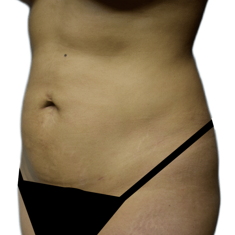Before Image: Tummy Tuck - left-front-oblique