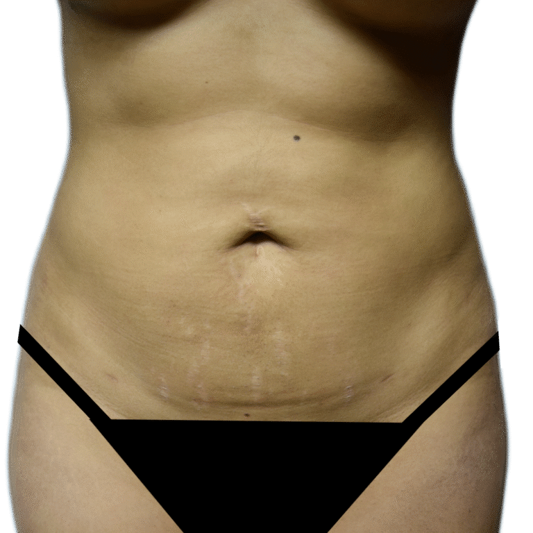 Before Image: Tummy Tuck - front