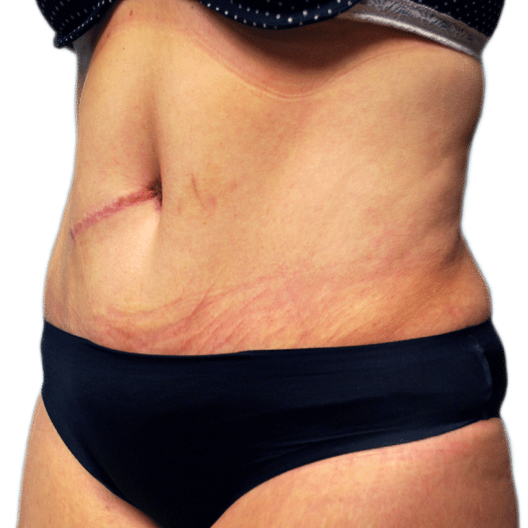 After Image: Tummy Tuck - left-front-oblique