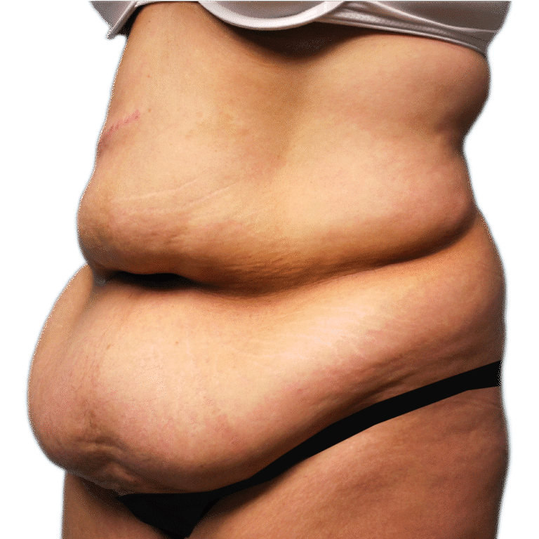 Before Image: Tummy Tuck - left-front-oblique