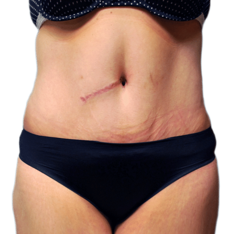 After Image: Tummy Tuck - front