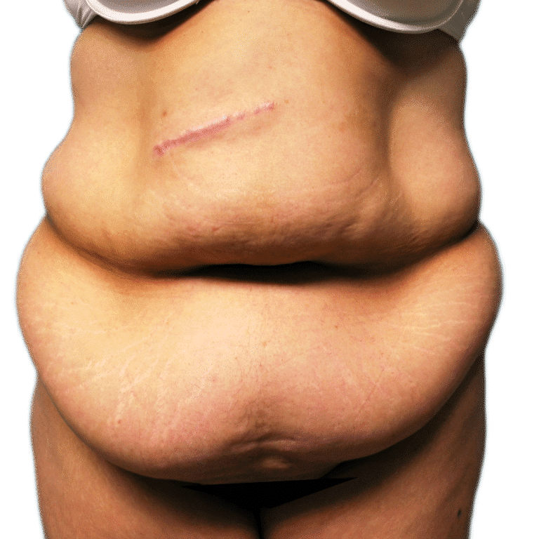 Before Image: Tummy Tuck - front