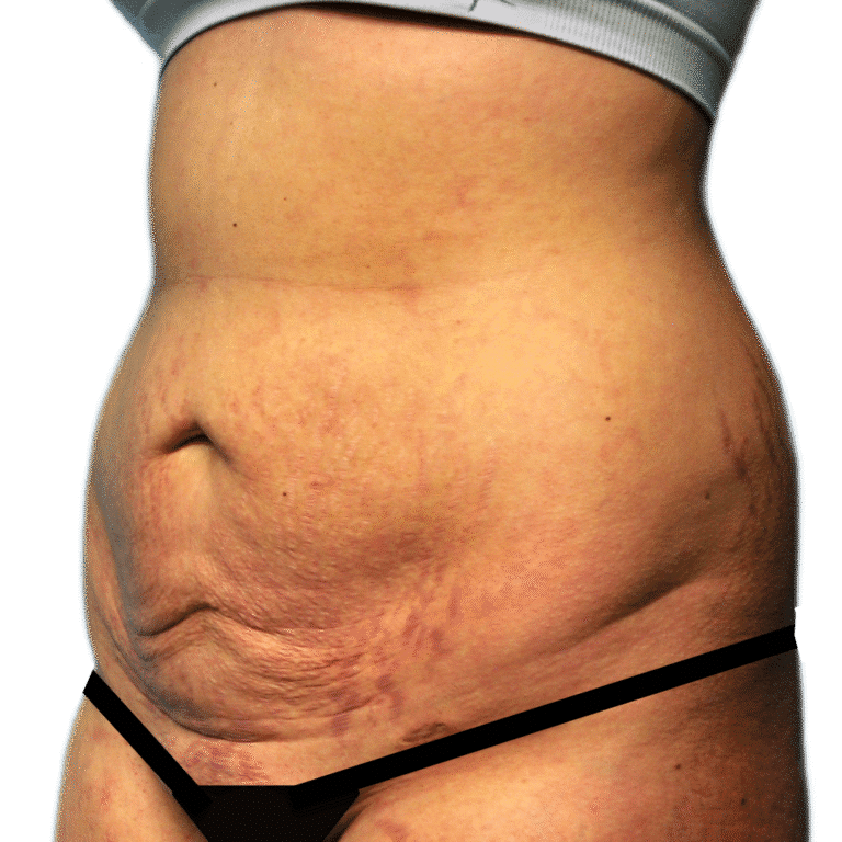 Before Image: Tummy Tuck - left-front-oblique
