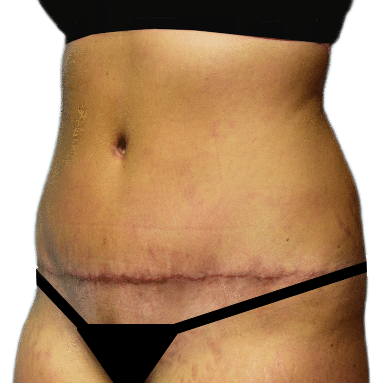 After Image: Tummy Tuck - left-front-oblique