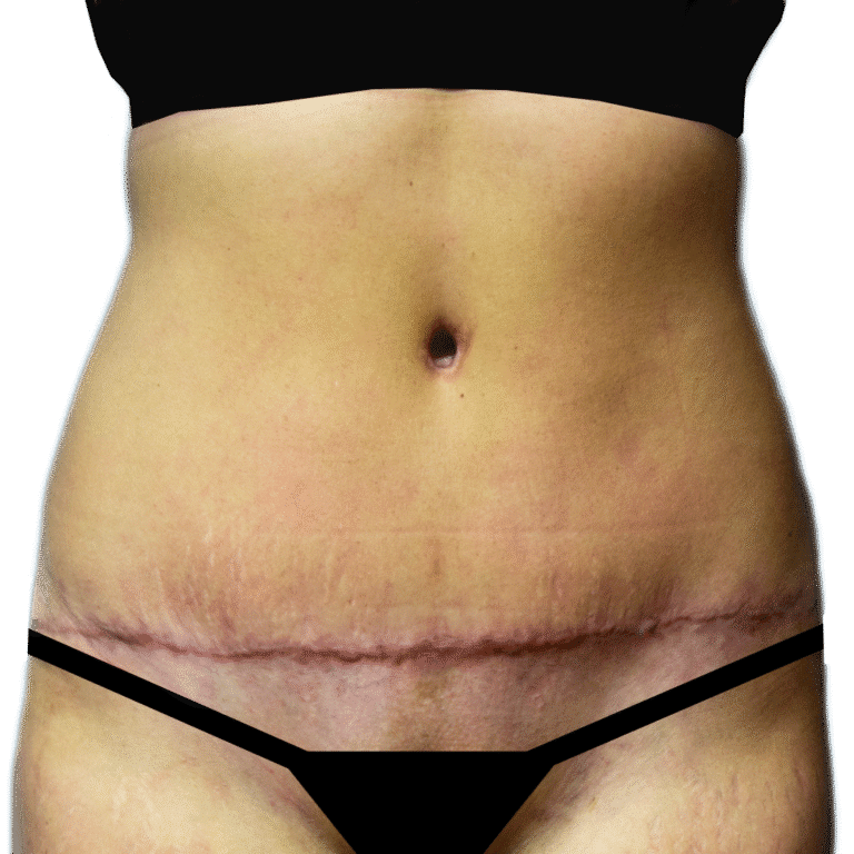After Image: Tummy Tuck - front