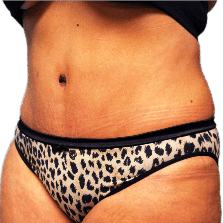 After Image: Tummy Tuck - left-front-oblique