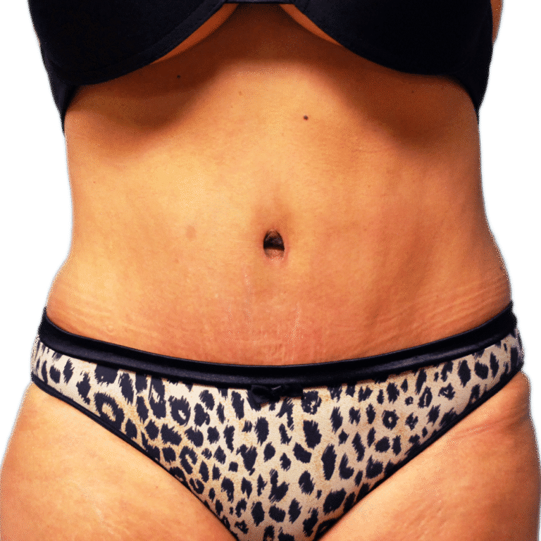 After Image: Tummy Tuck - front