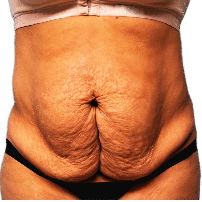 Before Image: Tummy Tuck - front