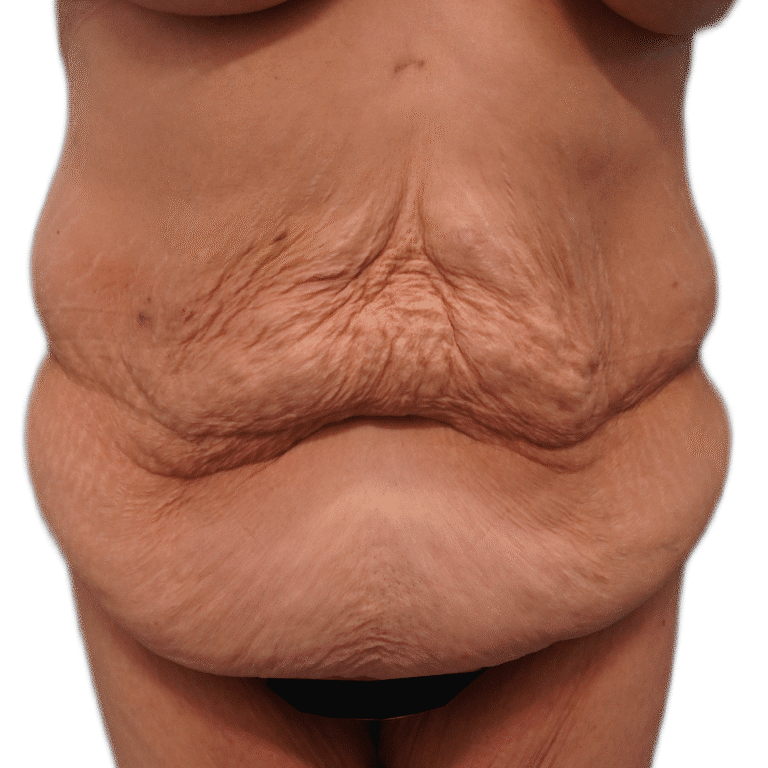 Before Image: Tummy Tuck - front