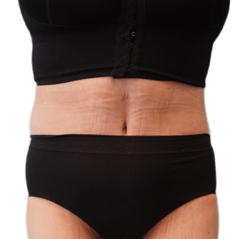 After Image: Tummy Tuck - front