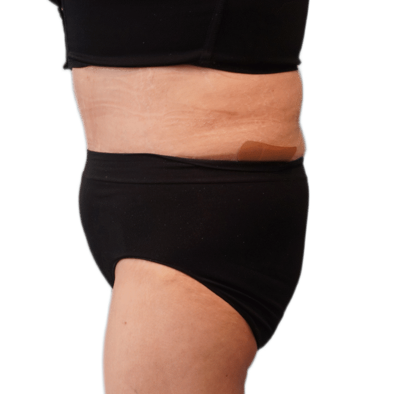 After Image: Tummy Tuck - left-side