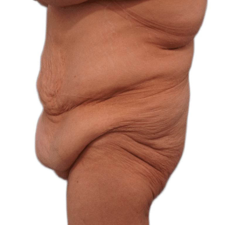 Before Image: Tummy Tuck - left-side