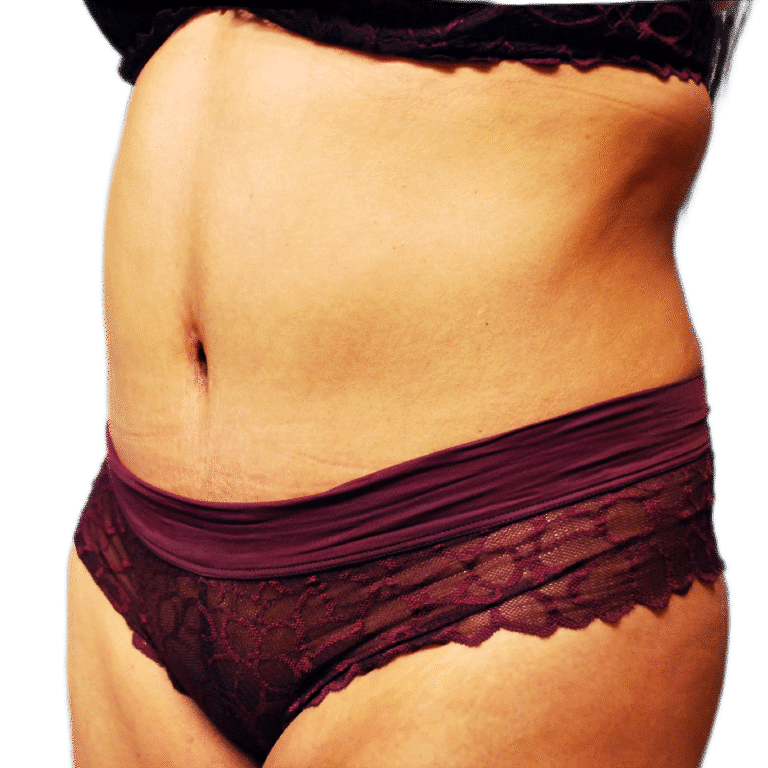 After Image: Tummy Tuck - left-front-oblique