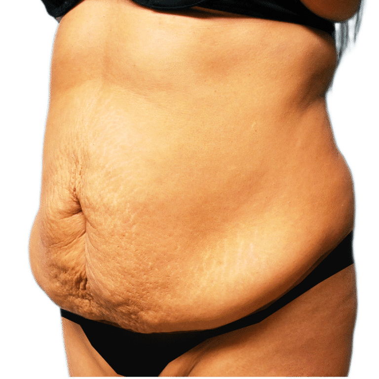 Before Image: Tummy Tuck - left-front-oblique