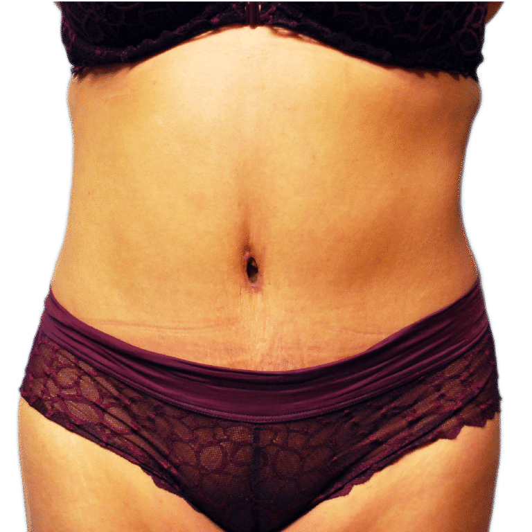 After Image: Tummy Tuck - front