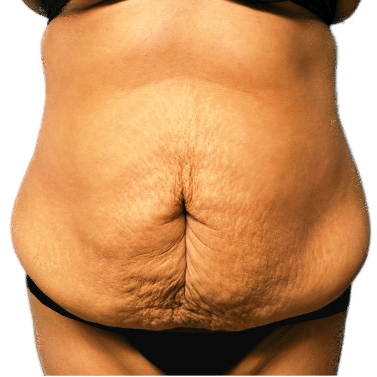 Before Image: Tummy Tuck - front