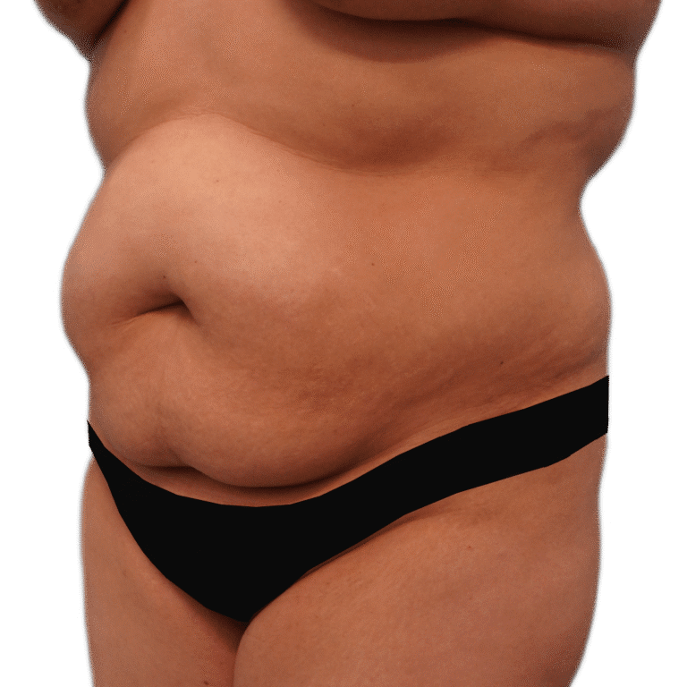 Before Image: Tummy Tuck w/ Lipo - left-front-oblique