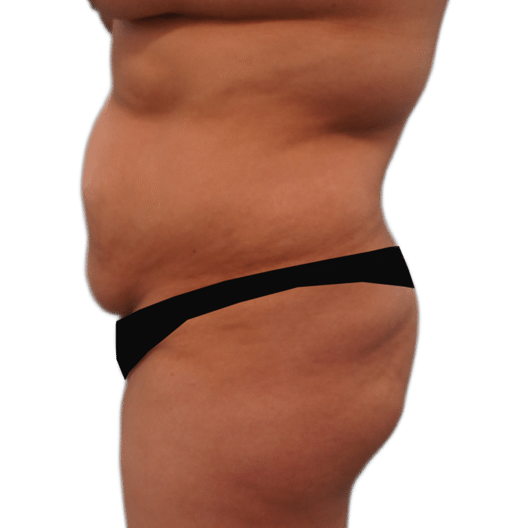 Before Image: Tummy Tuck w/ Lipo - left-side