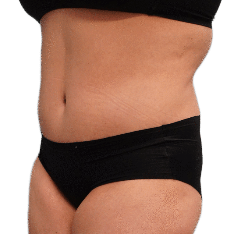 After Image: Tummy Tuck w/ Lipo - left-front-oblique