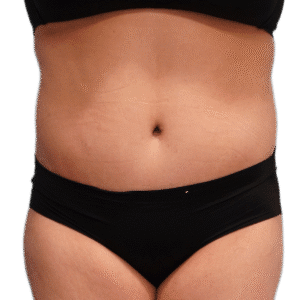 After Image: Tummy Tuck w/ Lipo