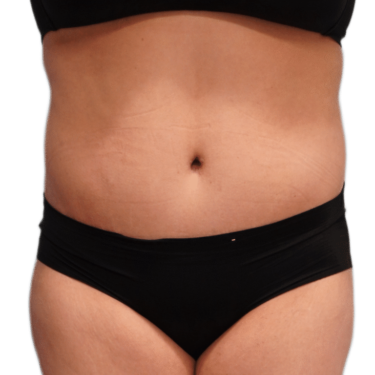 After Image: Tummy Tuck w/ Lipo - front