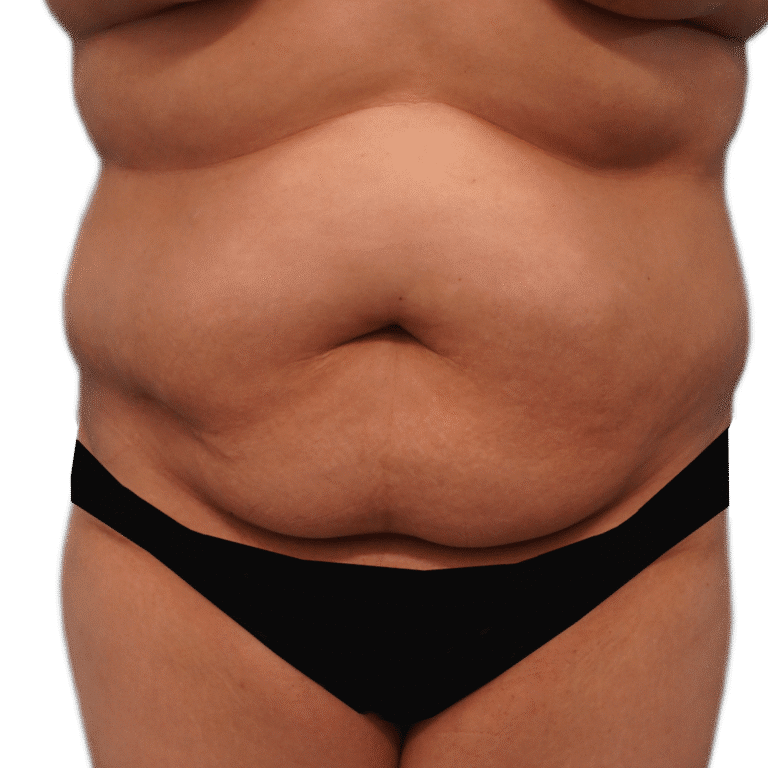 Before Image: Tummy Tuck w/ Lipo - front