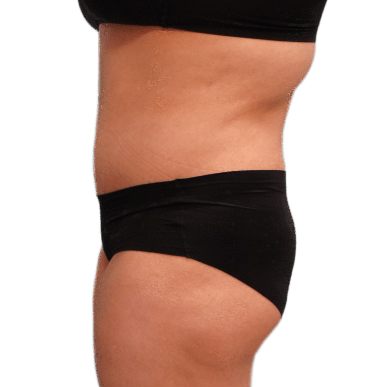 After Image: Tummy Tuck w/ Lipo - left-side