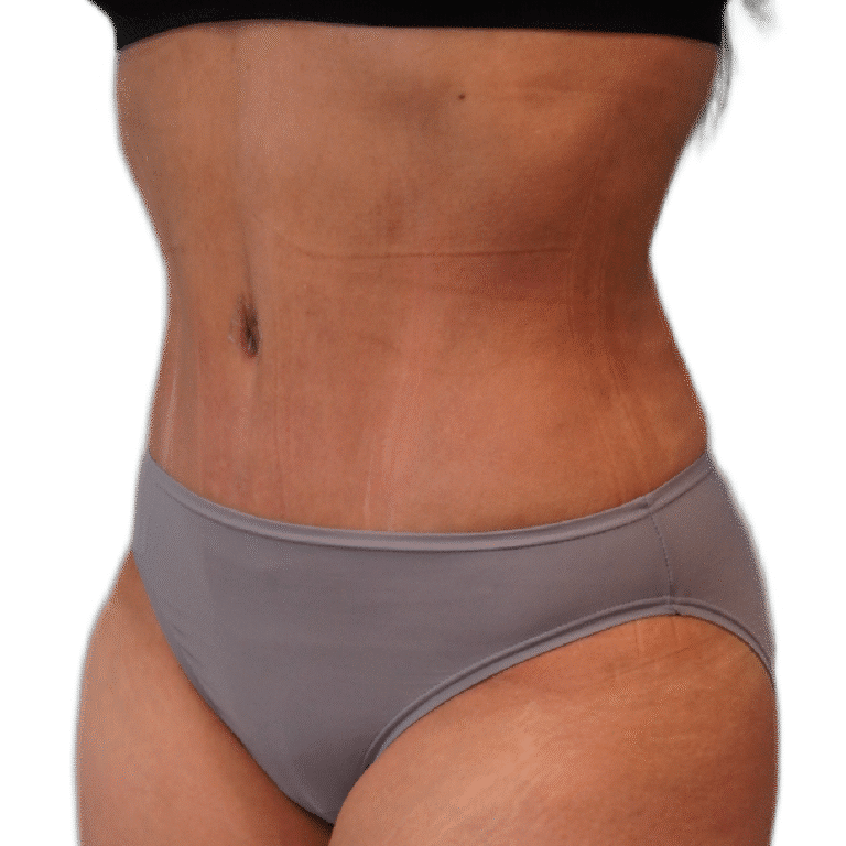 After Image: Tummy Tuck - left-front-oblique