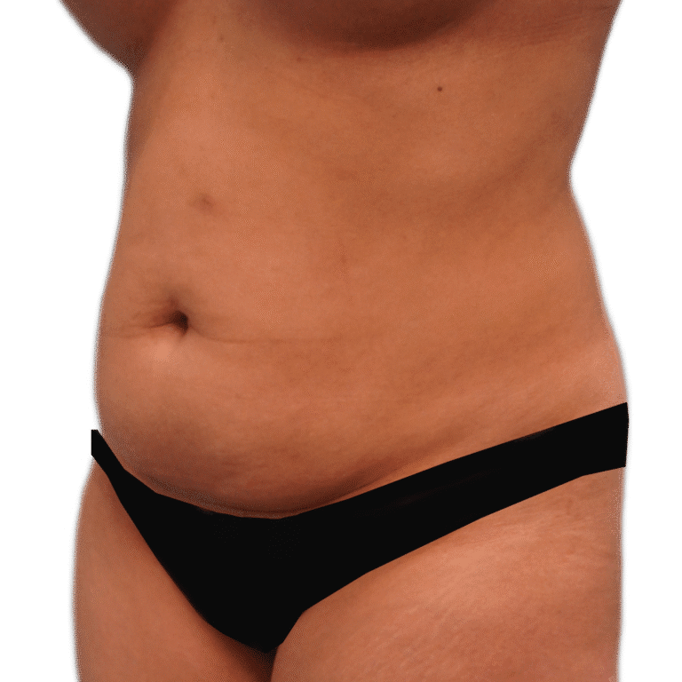 Before Image: Tummy Tuck - left-front-oblique