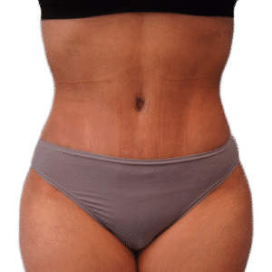 After Image: Tummy Tuck
