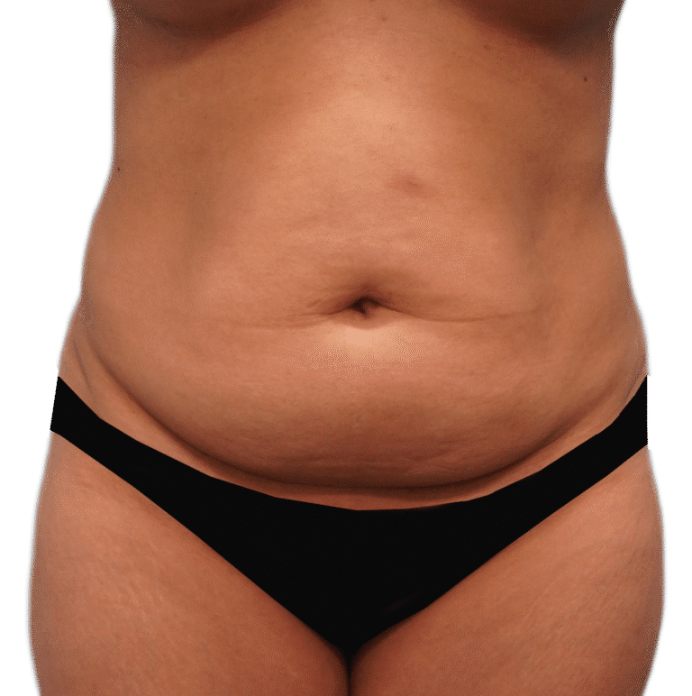 Before Image: Tummy Tuck - front