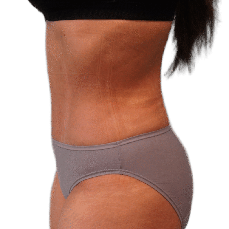 After Image: Tummy Tuck - left-side