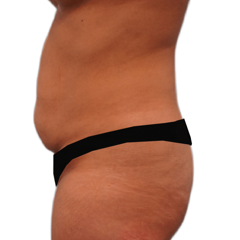 Before Image: Tummy Tuck - left-side