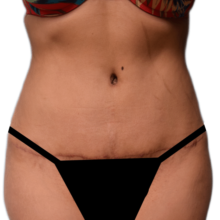After Image: Tummy Tuck - front